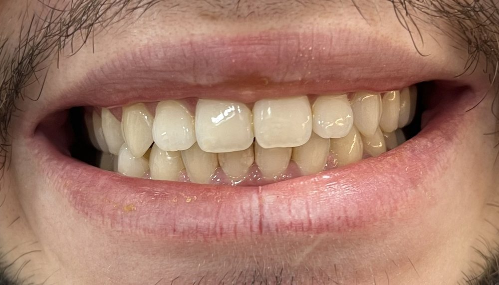 Sorriso antes do clareamento dental