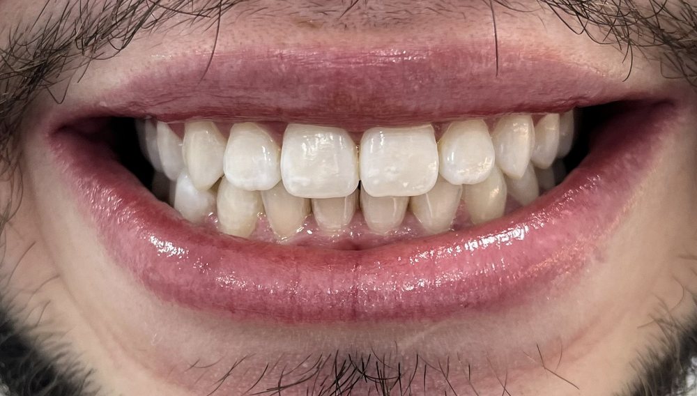 Sorriso depois do clareamento dental