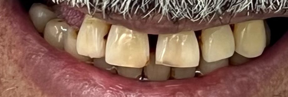 Sorriso antes da reabilitação protética